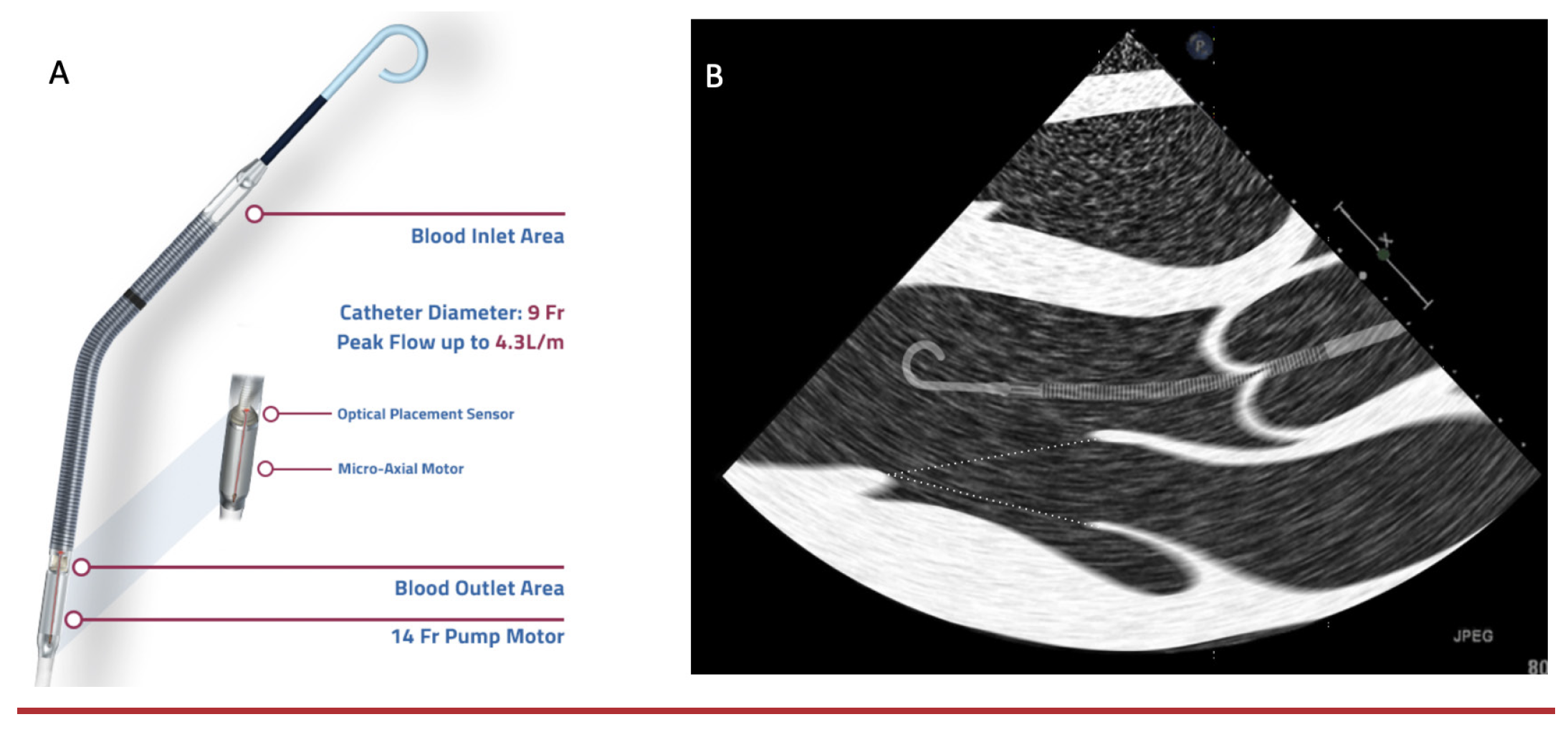 Impella in Acute Myocardial InfarctionCardiogenic Shock
